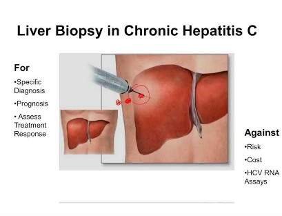LIVER BIOPSY