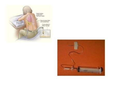 Thoracentesis