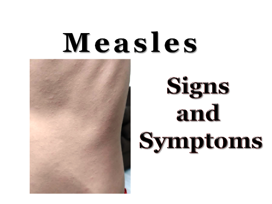 Measles signs and symptoms