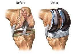 Surgical Management for Joint Pains