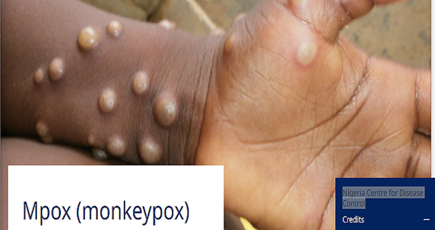 monkeypox